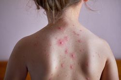 Thủy đậu giai đoạn khởi phát: Có nguy hiểm không? Cần xử trí như thế nào?