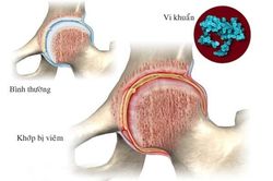 Chớ xem thường viêm khớp nhiễm khuẩn