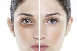 Tạm biệt quầng thâm mắt hiệu quả bằng những phương pháp đơn giản