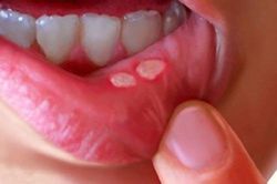 Thực phẩm cần kiêng khi bị nhiệt miệng