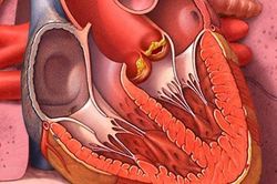 Đề phòng viêm nội tâm mạc do nhiễm khuẩn răng miệng
