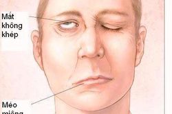 Giữ ấm trong ngày lạnh - Cách phòng ngừa liệt mặt hiệu quả