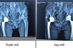 Phẫu thuật thay hai khớp háng cho bệnh nhân hoại tử vô khuẩn chỏm xương đùi