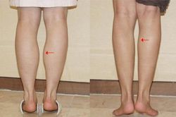 Giảm mỡ bắp chân không hề khó như bạn nghĩ