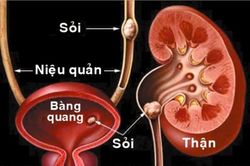 Biến chứng khó lường của sỏi niệu quản