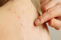 2 cách đơn giản giúp bạn xóa sẹo thủy đậu ngay tại nhà