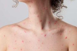 Thủy đậu có lây không? Đâu là con đường lây lan bệnh thủy đậu?