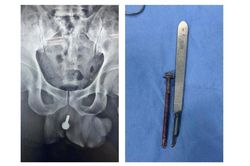Phẫu thuật bán khẩn lấy dị vật dài 6cm khỏi niệu đạo người đàn ông