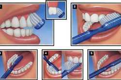 Đối phó với sâu răng