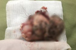 Hải Dương: Bé gái 7 tuổi có u quái chứa đầy răng và tóc trong ổ bụng