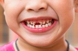 Ảnh hưởng của sâu răng sữa
