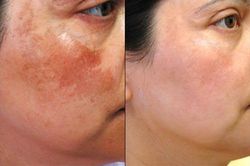Nghệ ngâm giấm: Hỗn hợp trị nám da tại nhà hiệu quả không cần mỹ phẩm?