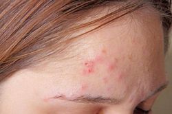 4 công thức trị mụn trứng cá tại nhà ai cũng làm được