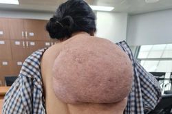 Người phụ nữ Thanh Hóa cõng 'mai rùa' suốt 30 năm