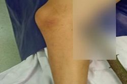 Bé trai 11 tuổi bị cành cây đâm xuyên đùi