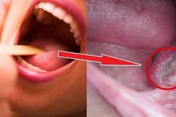 Bệnh ung thư vòm họng nên và không nên ăn gì?