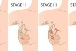 Phối hợp phẫu thuật và xạ trị cho bệnh nhân ung thư biểu mô tuyến vú không xâm lấn
