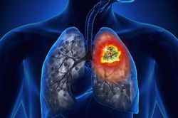 Kết hợp hóa trị và liệu pháp miễn dịch trong điều trị ung thư phổi