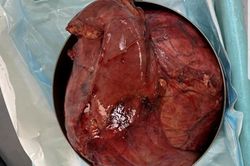 Tăng cân bất thường, cô gái không ngờ mang khối u hiếm gặp