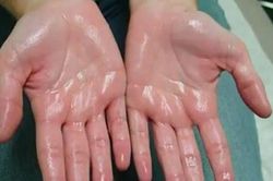 Bệnh đổ mồ hôi chân, tay trong những ngày lạnh: Cách điều trị hiệu quả tại nhà