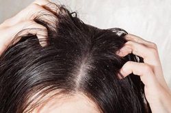 4 công thức sạch gàu với chanh không mất tiền