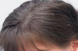 Trị gàu tận gốc tại nhà có thể bạn chưa biết