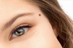 Nốt ruồi để làm duyên và bệnh lý