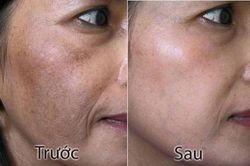 Dùng đá lạnh khoai tây nám da bao nhiêu cũng được lột sạch