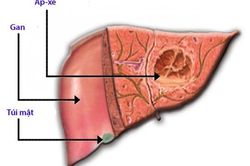 Áp-xe gan do amip có nguy hiểm?