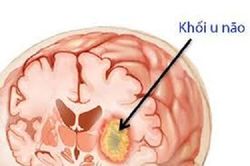 Độc tố trong thịt chưa nấu chín có liên quan đến u não hiếm gặp