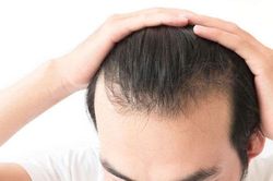 2 cách trị hói đầu tại nhà không tốn kém