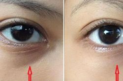 3 cách chữa thâm mắt vô cùng đơn giản