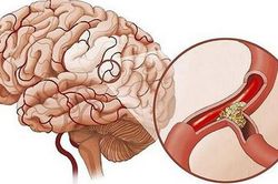 Nhận biết thiểu năng tuần hoàn não