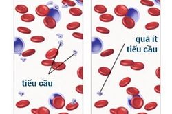 Đề phòng biến chứng xuất huyết giảm tiểu cầu vô căn