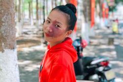 'Vết bớt trên mặt là món quà của cha mẹ'