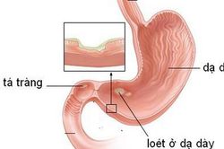 Dùng thuốc giảm đau, coi chừng loét dạ dày - tá tràng