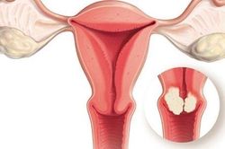 Dấu hiệu buồng trứng đa nang