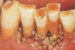 Chuyện lạ: Phát hiện ổ giòi trong lợi bé gái