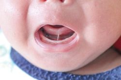 Dính thắng lưỡi ở trẻ nhỏ