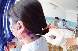 Mùa bệnh thủy đậu