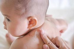 Ngăn ngừa, giảm nhẹ nhiễm trùng eczema ở trẻ