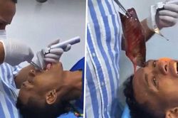 Chàng trai suýt chết vì con cá 18 cm kẹt trong cổ họng theo cách 'khó đỡ'