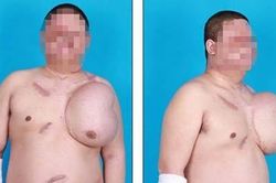 Chuyện lạ: Chàng trai 'mọc' đầu ở ngực