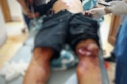 Hà Tĩnh: Nam thanh niên bị mất bàn tay sau vụ nổ lớn