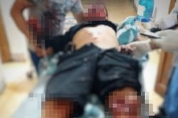 Hà Tĩnh: Nam thanh niên bị mất bàn tay sau vụ nổ lớn