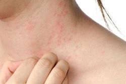 Dị ứng thực phẩm ngày Tết: Triệu chứng và cách phòng tránh