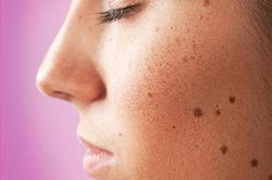 3 điều cần làm tốt để không bị đốm đồi mồi trên da