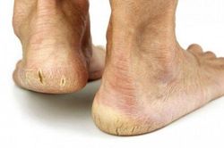5 bước đơn giản hết ngay nứt nẻ gót chân