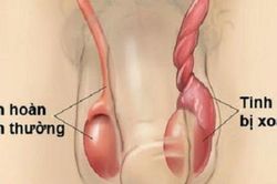 Nam giới chớ chủ quan với xoắn tinh hoàn