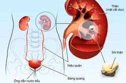 Những thói quen gây ung thư thận nhiều người mắc phải